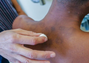 Janeiro Roxo alerta para a conscientização sobre a hanseníase