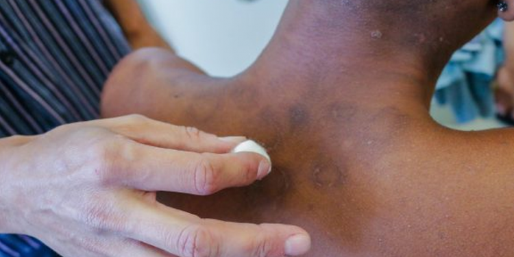 Janeiro Roxo alerta para a conscientização sobre a hanseníase