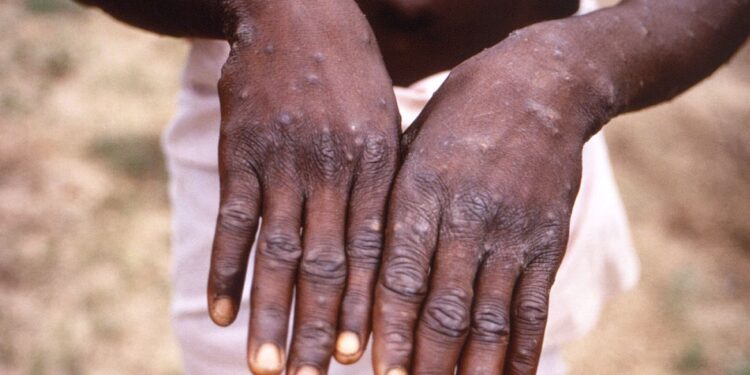 Governo cria comissão para acompanhar casos de varíola de macacos