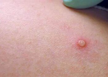 Brasil registra casos de varíola dos macacos em dois bebês