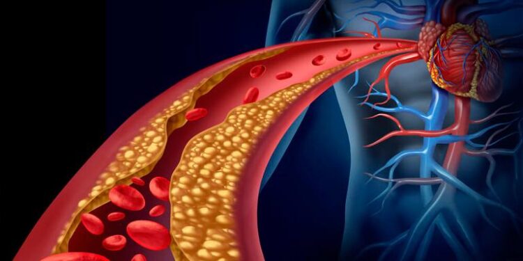 Colesterol alto é fator de risco para doenças cardiovasculares