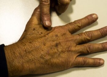 Tecnologia para tratar câncer de pele é aprovado para uso no SUS