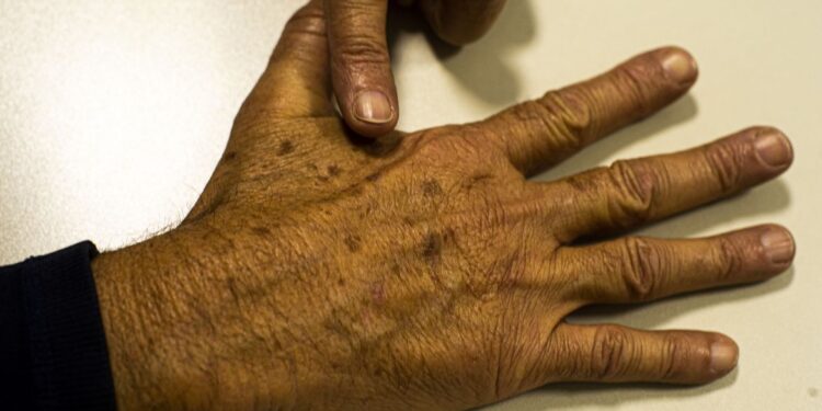 Tecnologia para tratar câncer de pele é aprovado para uso no SUS