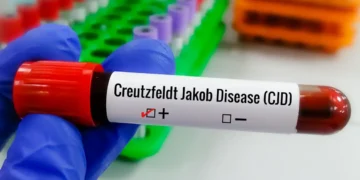 Entenda Doença de Creutzfeldt-Jakob, diagnóstico do piloto Lito Souza