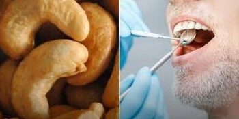 Do caju para o consultório: UFC cria resina dentária com casca da castanha