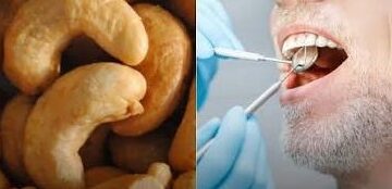 Do caju para o consultório: UFC cria resina dentária com casca da castanha